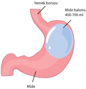 MİDE BALONU