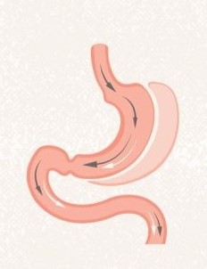 OBEZİTE CERRAHİSİ